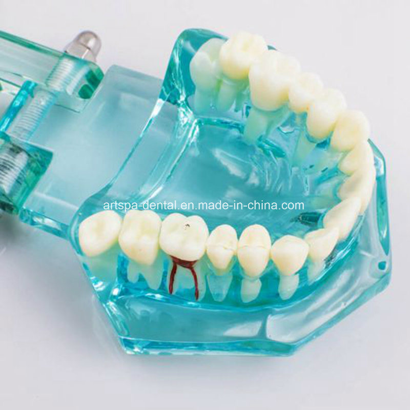 Dental Study Tooth Transparent Adult Pathological Teeth Model