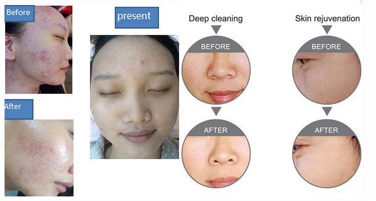 2017 Water Oxygen Jet Peel for Skin Care Deep Cleaning