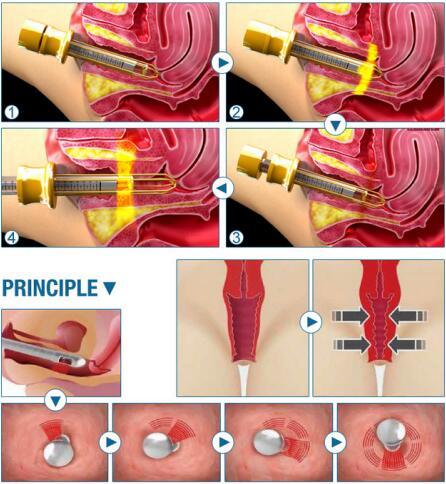 Fractional CO2 Laser Beauty Equipment with Vaginal Tightening