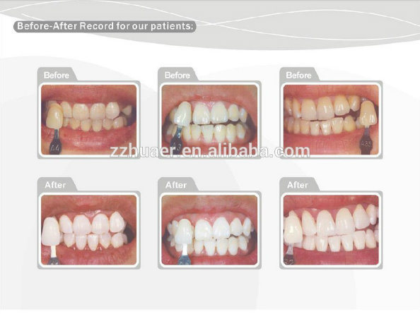 Clinic Professional Teeth Whitening Kit Used Together with Whitening Light