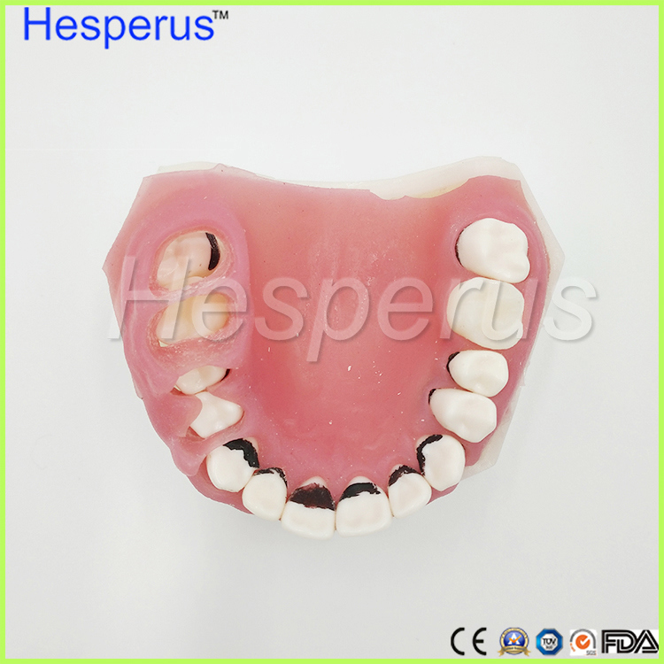 Dental Periodontal Disease Teeth Model / Tooth Medical Model Hesperus