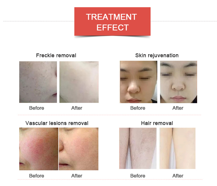 Opt IPL Beauty Equipment Face Clean Hair Removal