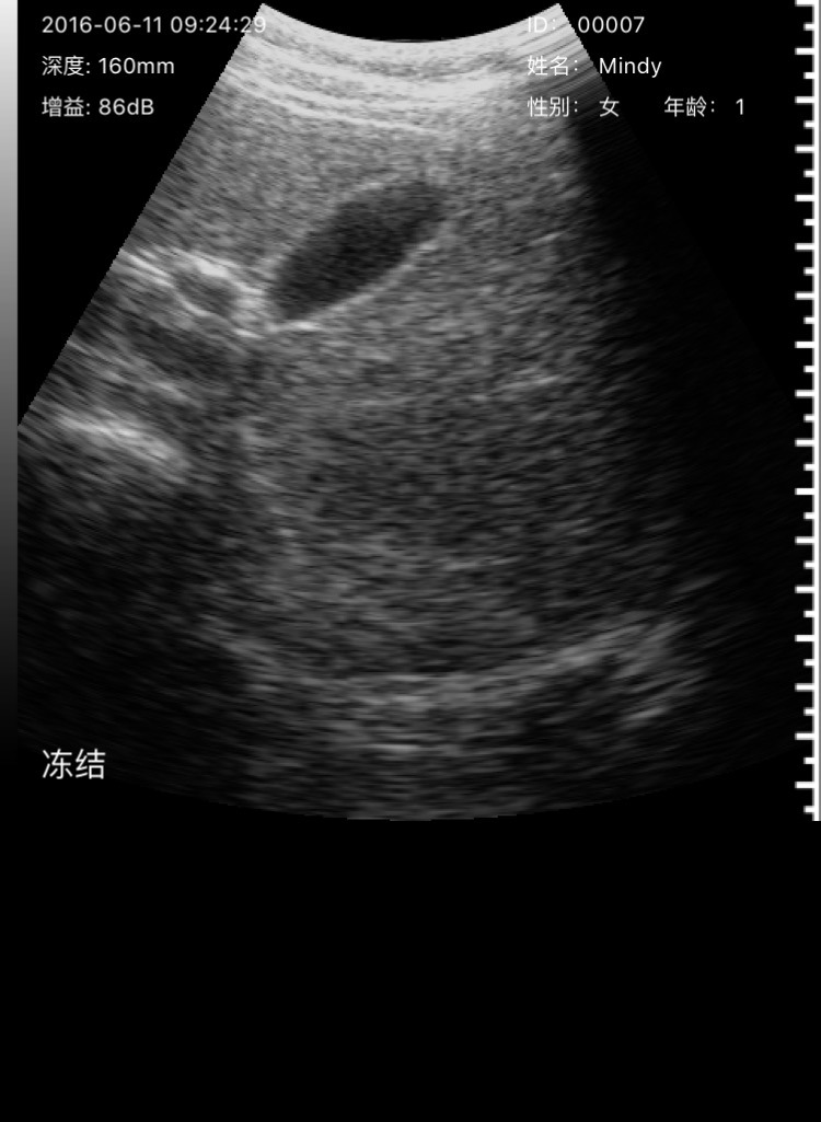 Determination Obstetric Ultrasound Diagnosis of Fetal Gender/Unborn Baby Gender