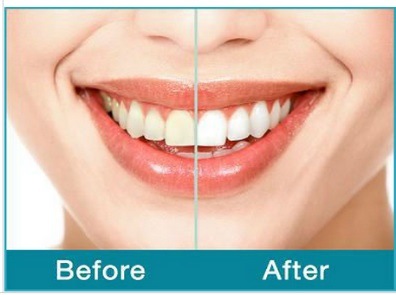 Super Best Home Teeth Whitening Kit with Mini LED Light