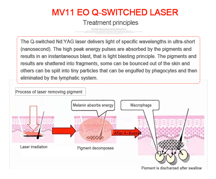 White ND YAG Q Switch Laser Honkon Tattoo Removal Machine