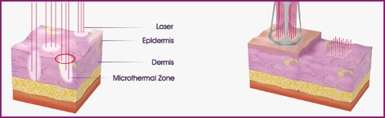 CO2 Fractional Laser Pigment Treatment Beauty Equipment