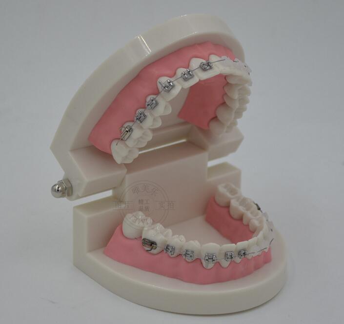 Dental Model of Teeth with Half Metal and Ceramic Bracket