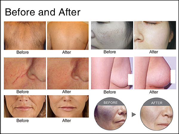 Newest Professional IPL Skin Rejuvenation Aft Shr (VE2020)