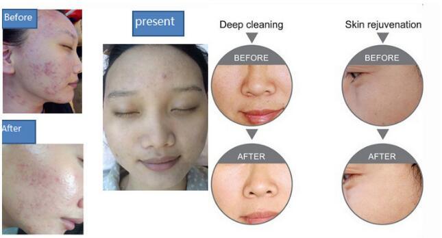 Water and Oxygen Jet Peel Facial Clear Wrinkle Removal