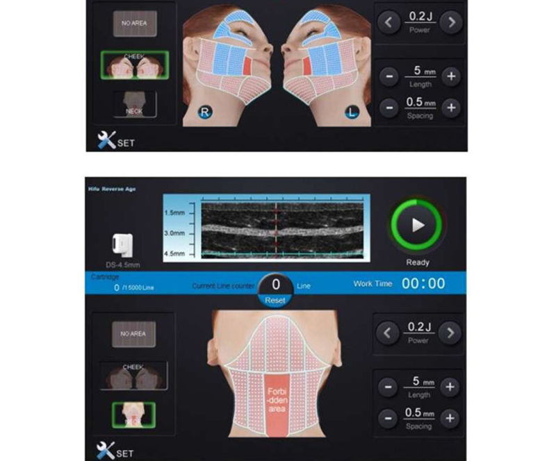 Fu4.5-2s High Intensity Focused Ultrasound Hifu Face Lift for Anti-Aging