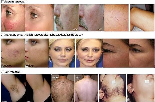 Shr IPL Skin Rejuvenation for Beauty Salon Machines