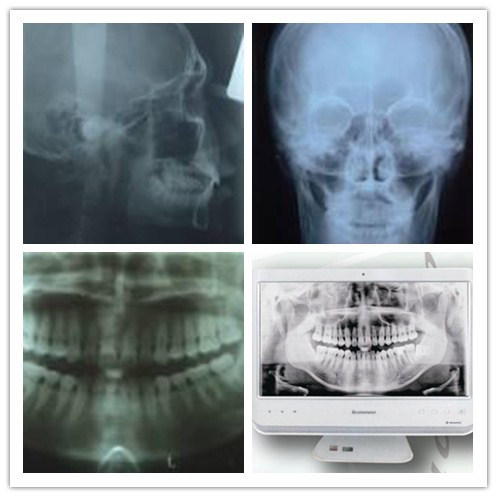 Dental Panoramic 8mA Medical Mobile Dental X-ray Digital Machine Msldx03