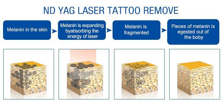 1000W 2000mj Touch Screen Laser Tattoo Removal 1064nm 532nm 1320nm Eyebrow Cleaner Pigments Removal Q Switch ND YAG Laser Machine