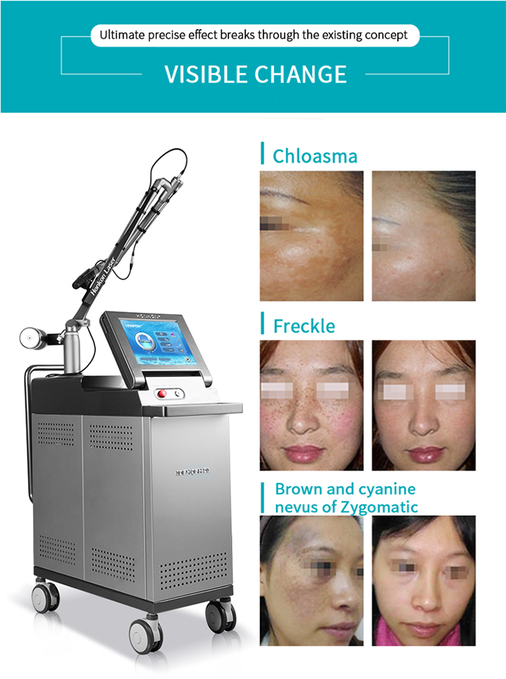 Honkon 1200mj Vertical Freckle Removal for Skin Rejuvenation Beauty Machine