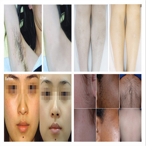 808nm for Permanent Fast Hair Removal