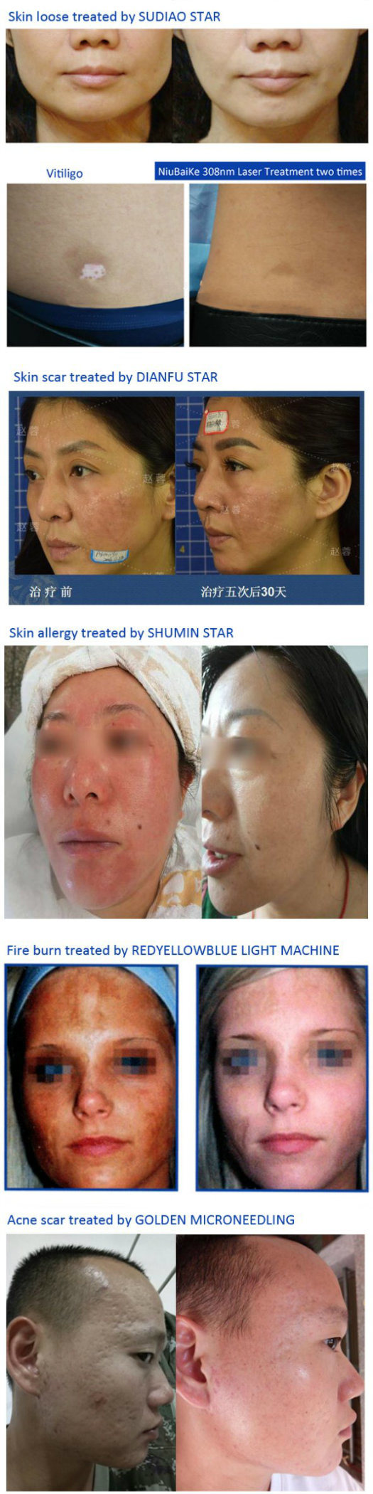 Hifu Skin Care Facial Multifunctional Beauty Medical Salon Equipment