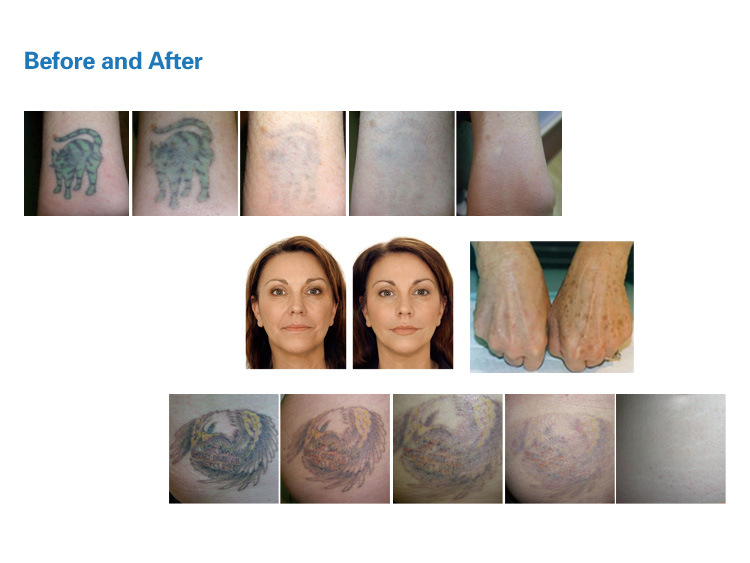 Q Switch ND YAG Laser Tattoo Removal and Pigment Problem