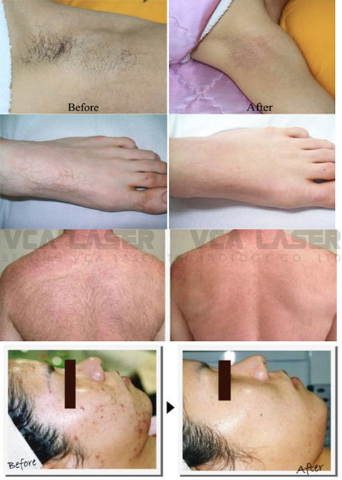 Effective IPL System Beauty Device IPL Hair Removal