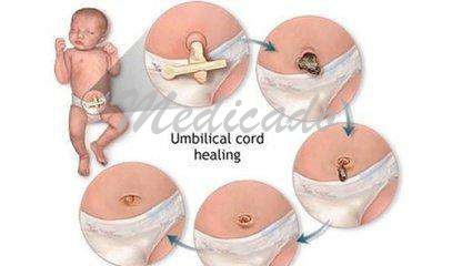 Disposable Umbilical Clamp with Hi-Q (high quality)
