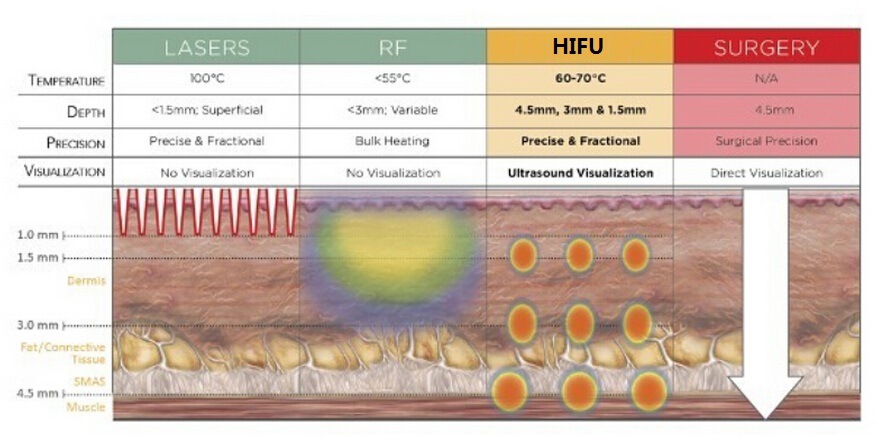 Popular Wrinkle Removal Hifu for Facial Lifting and Hifu Anti Aging