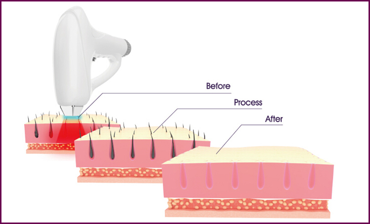 Portable Diode Laser 755nm Permenant Body Hair Removal Equipment