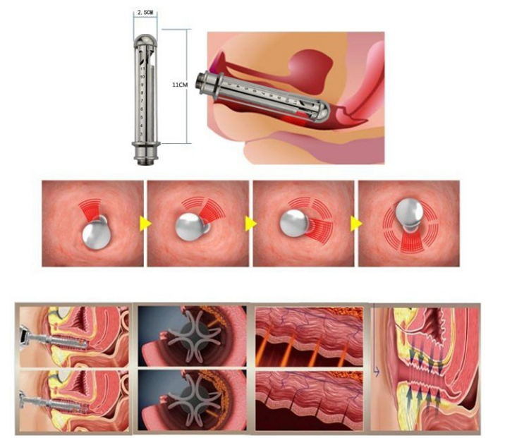 Stantionary Vaginal Tightening Scar Removal CO2 Fractional Laser Machine