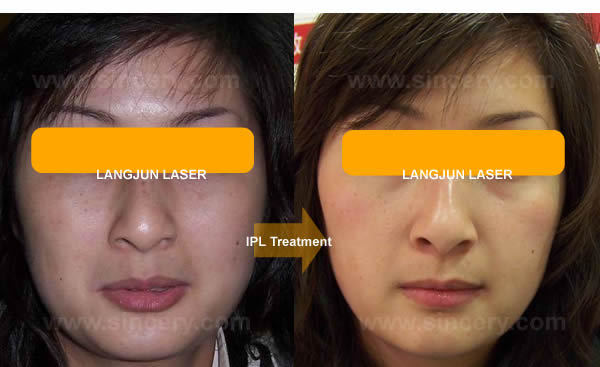 IPL (intense pulsed light) Skin Rejuvenation Hair Removal