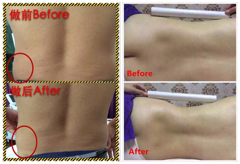 Liposonix Body Slimming Machine Hifu for Whole Body Shape Treatment