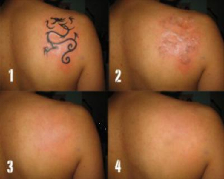 Skin Care Three Treatment Heads of Mini Laser Tattoo Removal