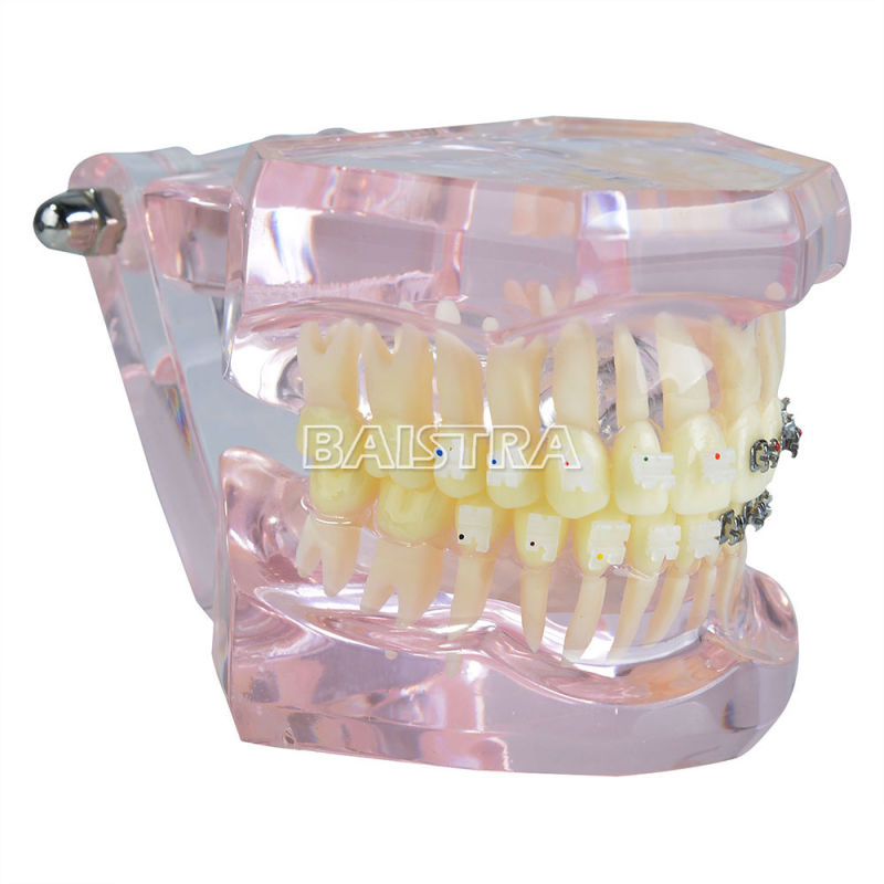 New Arrival Dental Model of Teeth with Ceramic Bracket