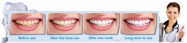 Professional Dental Care Free Peroxide Teeth Whitening Kit