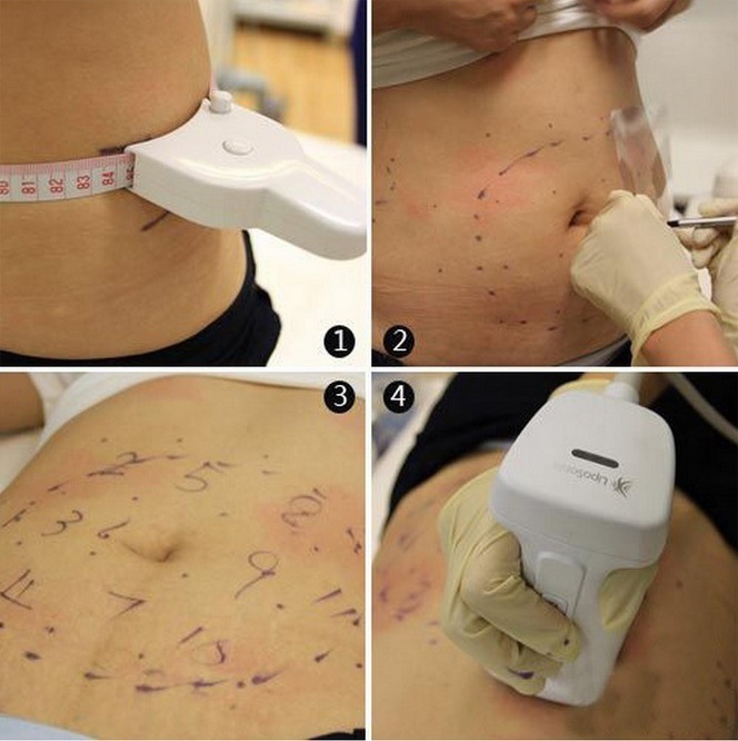 Liposonix Hifu Slimming Machine for Body Slimming Cellulite Removal