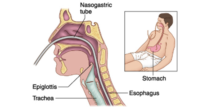 Disposable Feeding Tube for Gavage, Eternal Feeding and Tube Feeding for Single Use