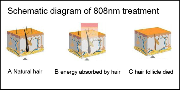 Portable 808nm Diode Laser Hair Removal