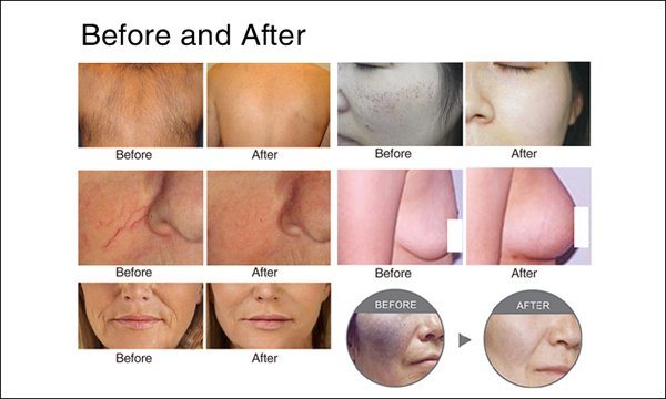 Home IPL Hair Removal & Wrinkle Removal Medical Beauty Equipment