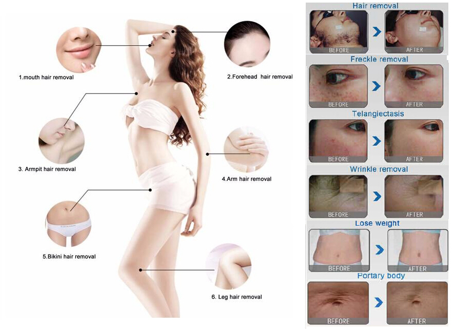 TUV Medical Ce Approval 4 in 1 Multi-Functional Laser IPL/Shr/ND YAG/RF/Hair/Tattoo Removal