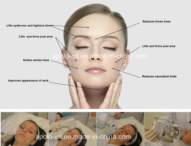 Deep Wrinkle Removal Hifu Body Sculpt High Intensity Ultrasound