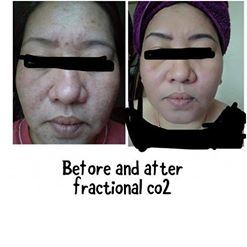 Alma Feminlift RF Fractional CO2 Laser for Scar Removal Skin Resurfacing Acne Scar Wrinkle Treatment Vaginal Rejuvenation