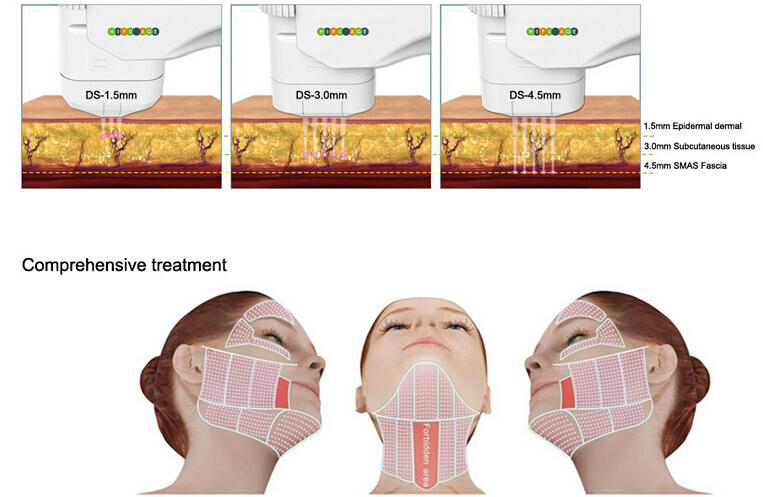 Chinloo Hifu Medical Face Lift Beauty Equipment (FU4.5-2S)
