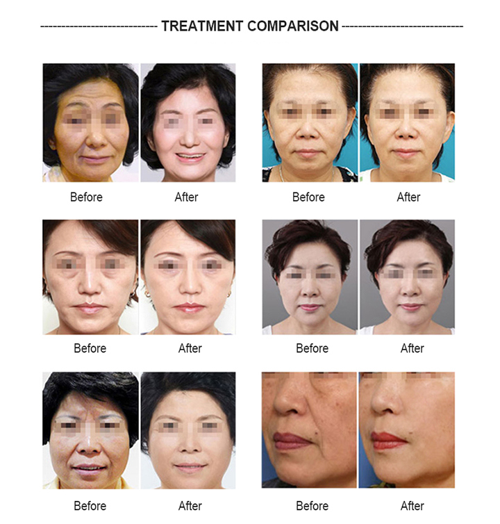 2018 Ultrasound Skin Tighten Facial Care Anti-Aging Machine