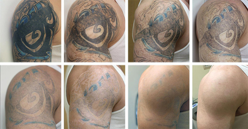 ND YAG Laser Tattoo Birthmark Freckle Age Sun Spot Removal Beauty Salon Machine