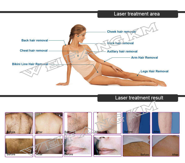 755nm Alexandrite Laser Permanent Hair Removal with Best Cooling System