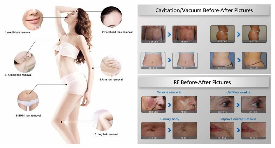 Ultrasonic Cavitation System RF Vacuum Weight Loss Medical Equipment Body Slimming Beauty Machine