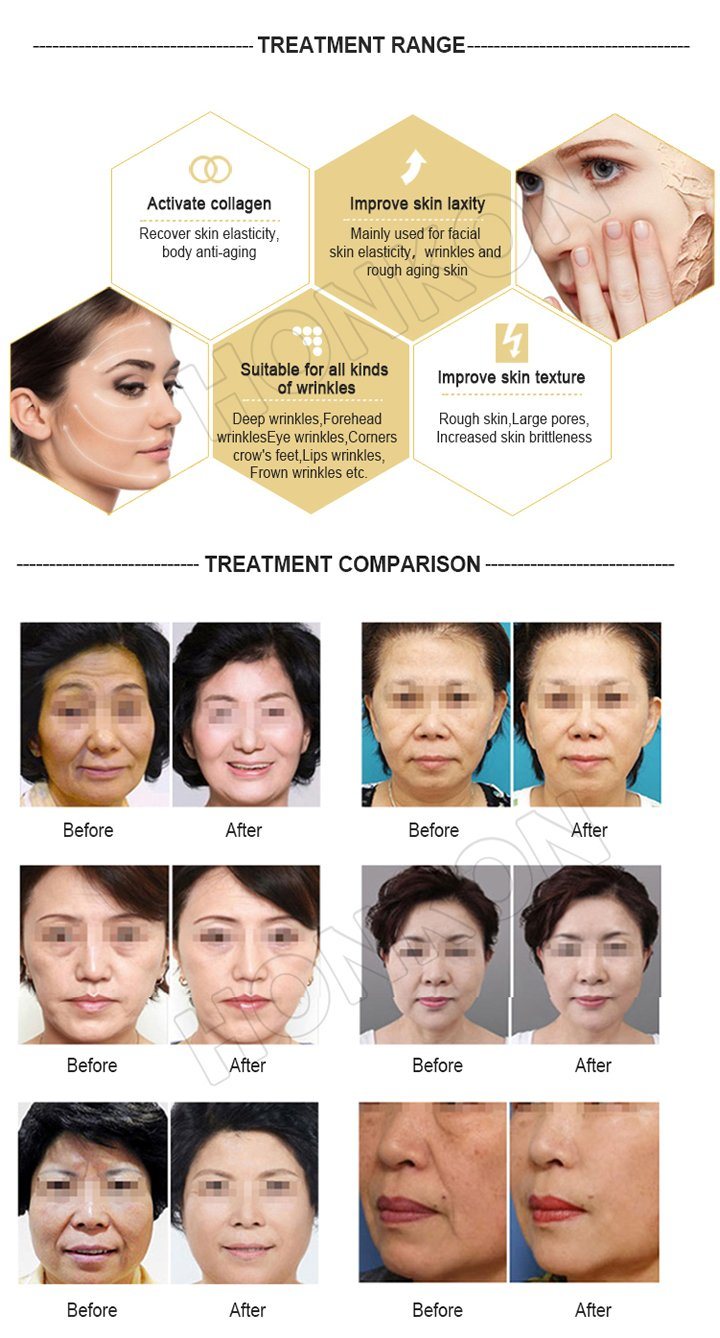 Professional Face Lifting Facial Wrinkle Removal by RF Beauty Machine