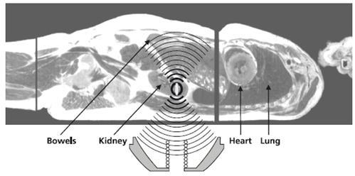 Eswl-Bi Extracorporeal Shock Wave Lithotripter with Ultrasound Scanner Location Function