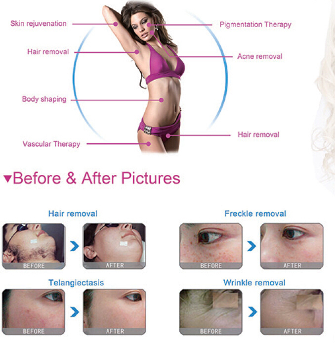 Fast Hair Removal Shr + Elight Beauty Machine (On Promotion)