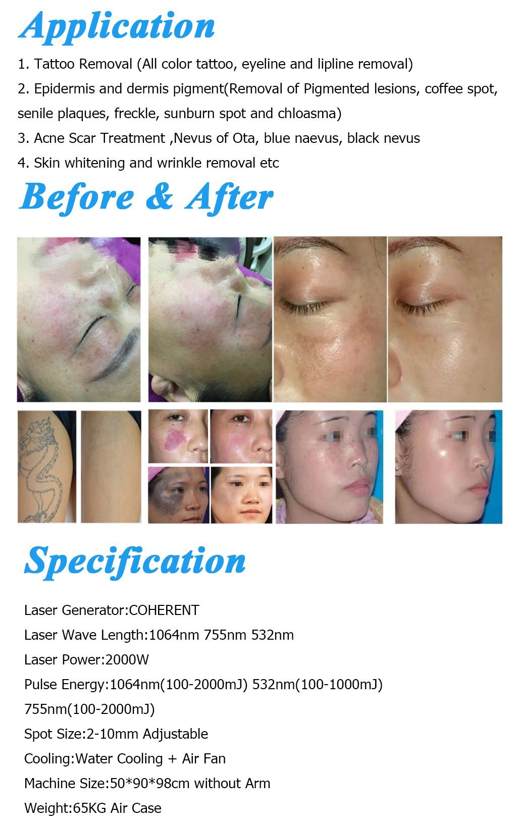 Carbon Cream Laser Tattoo Removal Pigmentation Treatment Solon Machine