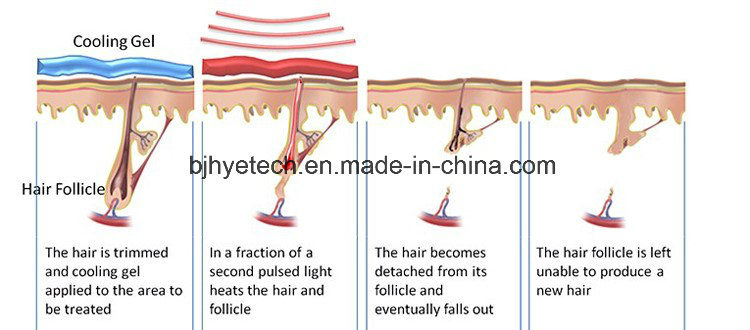 Factory Price Permanent 808nm Diode Laser Hair Removal Machine