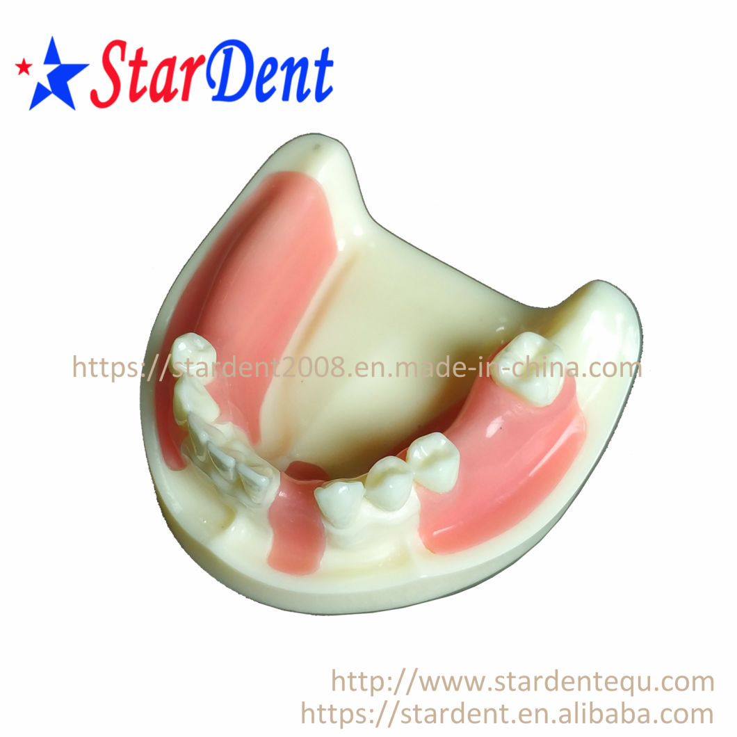 Dental Teeth Implant Practice Model