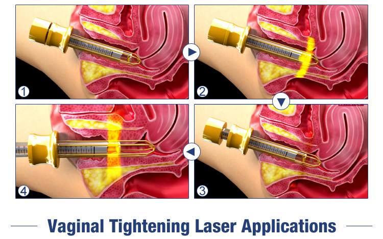 10600 Nm Scar Removal Fractional CO2 Laser Mslcf02/ CO2 Laser Scar Vaginal Tightening Laser System for Sale